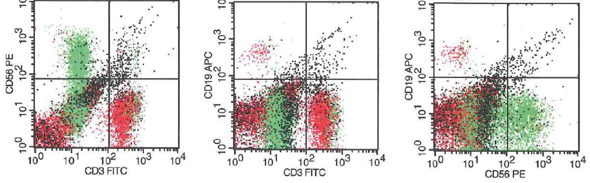 Atypical lymphoid cells are positive for CD56 and negative for surface CD3